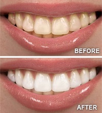 teeth whitening before and after