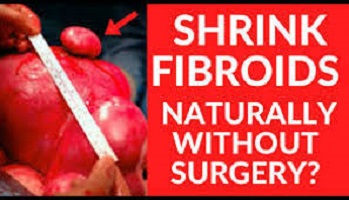 Herbs That Shrink Fibroid in Nigeria