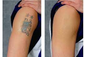 How to Remove Permanent Tattoo 10 Effective Ways to Try