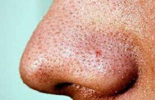 How to Get Rid of Blackheads at Home