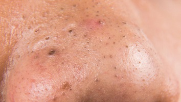 How to Get Rid Of Big Blackheads At Home • Ways to Get Rid of Blackheads and Big Pores • Blackhead Treatment • How to get rid of big Blackheads without Damaging Your Skin • How to Get Rid of Big Pores and Blackheads How to Get Rid Of Big Blackheads One of the most common types of acne is blackheads. Although people with oily skin are more prone to blackheads, they can occur in anyone. They form when your pores become clogged with dead skin cells and excess oil (sebum) from your sebaceous glands. Unlike whiteheads, which have closed pores, blackheads have open surfaces, resulting in a dark-colored oxidation. First, it's important to understand what causes blackheads. What are blackheads exactly? Many people consider blackheads to be one of the most common and stubborn skin conditions. When oil (sebum) and dead skin cells combine, they form a plug that clogs your pores and cause acne. Cleansing and exfoliating may be sufficient to loosen and draw the plug. However, if the plug hardens or becomes too deep to reach, you may be unable to remove the blackhead on your own. What’s the difference between blackheads vs. whiteheads? According to the American Academy of Dermatology, whiteheads, another type of acne that is equally aggravating, are actually closed comedones (AAD). "A whitehead is essentially the same as a blackhead, except there is a little skin on top of the follicle," says board-certified dermatologist Ife J. Rodney, M.D., founding director of Eternal Dermatology + Aesthetics and dermatology professor at Howard University and George Washington University. This protective layer keeps them from oxidizing, so they appear white, pink, or flesh-colored instead. What Causes Blackheads? How do blackheads form? "Blackheads are caused by a buildup of sebum, oil, dead skin cells, and possibly C. acnes (the bacteria that causes acne) that become lodged in the hair follicle," explains Nazanin Saedi, MD, the director of Jefferson Laser Surgery and Cosmetic Dermatology Center in Philadelphia. "The opening turns black when these substances oxidize in the air," explains Dr. Saedi. How to Get Rid of Big Blackheads on Your Skin Suozzi recommends topical or oral retinoids, including prescription medications like tretinoin or Retin-A, to keep blackheads at bay. "Recently, an over-the-counter prescription strength retinoid called adapalene or Differin became available for the treatment of comedonal acne," she says. "In severe cases of comedonal acne, patients may require oral retinoids such as isotretinoin or Accutane." Chemical exfoliants can also be effective, according to Saedi, but she isn't a fan of scrubs because they can cause irritation. The Best Ways to Get Rid of big Blackheads If you have blackheads, which are caused by dead skin cells and oil clogging your pores, there are many ways to treat them. There are also methods to keep new ones from forming. But keep in mind that picking, squeezing, and popping blackheads aren't options. That approach could exacerbate your situation significantly. Instead, try some of these treatments. Here are a few home remedies for blackheads: • Tea tree oil: Tea tree oil has the ability to inhibit or prevent the growth of bacteria. Rub a small amount of tea tree oil on your blackheads with a cotton applicator. • Sugar or salt scrubs: Sugar and salt scrubs exfoliate dead skin cells on the skin's surface. Wet your face, apply a salt or sugar scrub to the affected areas, and massage your skin for up to 30 seconds in small, circular motions. When you're finished, rinse your face with water. • Green tea: Applying wet green tea leaves to your skin can help reduce oil production. Green tea is an antioxidant as well. Mix dry green tea leaves with water and massage the wet leaves into your skin for up to 30 seconds in small, circular motions. When you're finished, rinse your face with water. How to Remove Blackheads safely (and prevent them from coming back) Perhaps because blackheads are so common and frustrating, people have tried a plethora of strange (and sometimes dangerous) methods to remove them, such as the Reddit grits exfoliation technique and the DIY gelatin mask. So, what's the most effective way to get rid of blackheads on your face and body? Slow and steady wins the race, according to Dr. Lipner. And we've discovered that the best and least harmful methods for treating and preventing blackheads are on the simple side. "Keep in mind that you won't get instant gratification," Dr. Lipner advises. It may take up to a month to see clearer skin, but your patience will be rewarded. Following are dermatologist-approved tips for removing blackheads from head to toe, including your nose, chin, forehead, chest, and back. 1. Cleanse your face at least twice a day. 2. Wash your face after you exercise too. 3. Use pore strips carefully and sparingly. 4. Use physical exfoliants to keep oily skin clear. 5. Try chemical exfoliation for a gentler option. 6. Use a clay or charcoal mask occasionally. 7. Spot-treat clusters of blackheads. 8. Get extractions from a professional. 9. If you do try to extract your own blackheads, ice the skin after. 10. Know that self-tanning products can make blackheads more visible. 11. Wear (oil-free) sunscreen every day. 12. Avoid comedogenic makeup and skin-care products. 13. Try an over-the-counter retinoid product. 14. Talk to a dermatologist about prescription treatment options. 15. Wash your sheets and pillowcases regularly. Management and Treatment How are blackheads treated? Blackheads can be treated with over-the-counter medications. These could include: • Salicylic acid: This is available over-the-counter as a cleanser or lotion for blackheads. It aids in the removal of the top layer of damaged skin. Salicylic acid dissolves dead skin cells, keeping your hair follicles clear. • Azelaic acid: Azelaic acid is found naturally in barley, wheat, rye, and other grains. It kills skin microorganisms and reduces swelling. • Benzoyl peroxide: This is available as an over-the-counter product as a leave-on gel or wash (such as Clearasil®, Stridex®, and PanOxyl®). It targets surface bacteria, which frequently exacerbates acne. Lower concentrations and wash formulations are gentler on the skin. A common side effect is irritation (dryness). Retinoids (vitamin A derivatives): Retinoids such as Retin-A, Tazorac®, and Differin® (now available without a prescription) help to break up blackheads and whiteheads and prevent clogged pores. You may notice a change in the color of your skin or peeling. These side effects can be reduced by using retinoids every other day or at the same time as a moisturizer. If nonprescription medications do not clear up your blackheads, your doctor may suggest: • Retinoids with a prescription: Prescription retinoids are more potent than nonprescription retinoids. • Antibiotics taken orally: Antibiotics taken orally reduce the bacteria that cause blackheads. • Microdermabrasion: A dermatologist will "sand" your skin with a specialized instrument. The clogs that cause blackheads are released by removing the top layers of your skin. • Chemical peels: A mild chemical solution is used in chemical peels to remove layers of skin and reduce blackheads. • Laser skin resurfacing: Laser skin resurfacing targets your blackheads with short, concentrated pulsating light beams. The light beams reduce the amount of oil produced by your sebaceous glands. Do blackheads naturally disappear? Blackheads can sometimes disappear on their own, depending on how deep they are in your skin. If a blackhead is close to the skin's surface, it is more likely to disappear on its own. Some blackheads, on the other hand, can be deeply embedded in your skin. Deep, embedded blackheads are less likely to disappear naturally. A dermatologist or medical aesthetician can remove embedded blackheads. Is it safe to squeeze out blackheads? Squeezing or popping blackheads can be very tempting and satisfying. Squeezing out blackheads, on the other hand, can cause a number of issues: • It is not necessary to remove the entire blackhead. • You could push the blackhead deeper into your skin, causing painful irritation; or you could introduce bacteria or more oil into the blackhead opening. Your blackheads may grow in size or spread. • Scarring or inflammation. Your skin is sensitive, and your nails are far more powerful than your skin. When you apply a lot of pressure to your skin with your nails to remove a blackhead, you can irritate or seriously damage your skin. How do you remove deep blackheads? Deep blackheads should be removed by a dermatologist - usually a dermatologist or medical aesthetician. They apply even pressure to your blackheads with a small tool with rigid metal loops on the ends (blackhead or comedo extractor). They can safely remove the entire blackhead, reducing the likelihood of it recurring. How do you prevent blackheads? During normal hormonal changes, preventing blackheads is difficult, if not impossible. However, there are some things that can help: • Wash your face twice a day with warm water and a gentle facial cleanser. • Apply moisturizer on a regular basis. • You do not have to stop wearing makeup, but you should try to use "noncomedogenic" products and remove your makeup at the end of each day. • Keep your fingers away from your face FAQs How to remove a blackhead that won't come out How to extract a blackhead • Wash your hands • Apply pressure around the clogged pore • Rock your fingers back and forth around the clogged pore • Feel the clog pop out • Cleanse the area with a mild astringent or toner Deep rooted blackhead removal at home How to Get Rid of Blackheads the Right Way 1. Wash with a gentle cleanser 2. Steam your face 3. If you must squeeze, never use your nails 4. Better yet, use an extractor tool 5. Exfoliate regularly 6. Use a pore strip 7. Make sure to moisturize 8. Apply a topical retinoid. How to remove blackheads with Vaseline ~ can Vaseline cure blackheads? Dermatologists Weigh in on the Vaseline Method "I would never recommend this method to any patient," dermatologist William Kwan, MD, of San Francisco, told Health. "Vaseline can clog pores, and using plastic wrap physically obstructs the pores. How do you get rid of deep root blackheads? How to Get Rid of Big Blackheads A dermatologist or medical aesthetician should remove deep blackheads. They apply even pressure to your blackheads with a small tool with rigid metal loops on the ends (blackhead or comedo extractor). How can you remove deep blackheads at home? Exfoliate Once a week, exfoliate your skin to help remove dead skin cells that contribute to blackheads. A scrub can also help to improve the appearance of the skin. Exfoliating should be avoided if it irritates the skin, and using a scrub should be discontinued if it causes the skin to feel dry or sore. How does Vaseline get rid of blackheads in 5 minutes? 'Petroleum jelly dilutes the dried up oxidized oil, resulting in a hard-topped plug of oil in the pore that is easier to squeeze out and clear. How to Get Rid of Blackheads Learn more about our screening process. 1. What you are capable of. One of the most common types of acne is blackheads. 2. Cleanse with salicylic acid. 3. Gently exfoliate with AHAs and lactic acid 4. Pick up a skin brush. 5. Try topical retinoids. 6. Use a clay mask. 7. Use a charcoal mask. 8. Consider a chemical peel. Can I remove blackheads on my own? Most people can get away with removing a blackhead once in a while, but it's important not to make it a habit. Make an appointment with a dermatologist if you have recurring blackheads so that you can address them with more permanent treatment options. What is the fastest way to remove blackheads? The Best Ways to Remove Blackheads 1. Use Salicylic Acid Products. 2. Think about Alpha Hydroxy Acids. 3. Think about Alpha Hydroxy Acids. 4. Using Abrasive Scrubs. 5. Performing Manual Extraction 6. Using Suction Devices. 7. Add a Retinoid to Your Routine How can I get rid of blackheads on my face at home? Green tea, tea tree oil, salt scrub, and sugar scrub are all home remedies for blackheads. Green tea reduces oil production on the skin, while tea tree oil inhibits bacterial growth. The salt or sugar scrub exfoliates your skin and removes dead skin cells that clog open skin pores. What causes blackheads to disappear overnight? Dr. Bank recommends a two-step procedure to help blackheads disappear by morning: Before going to bed, use a pore strip followed by a salicylic acid gel. Be gentle if you have blackheads on your cheeks. How can blackheads be permanently removed? However, for blackheads, regular exfoliation can help remove excess dead skin cells that can lead to clogged pores. The procedure may also be used to gently remove existing blackheads. Instead of looking for harsh scrubs, concentrate on alpha and beta hydroxy acids (AHAs and BHAs). Years of deep blackheads Deep blackheads can linger for years. Deep blackheads are the result of a buildup that has occurred over a period of weeks, months, or even years. When a pore becomes clogged, oil accumulates deeper within the pore. If blackheads are not removed promptly, they can remain in the skin indefinitely. How to remove deep blackheads on nose Deep blackheads should be removed by a doctor, usually a dermatologist or medical aesthetician. They apply even pressure to your blackheads with a small tool with rigid metal loops on the ends (blackhead or comedo extractor). How do you get deep blackheads to come up to the surface? Exfoliate. Once a week, exfoliate your skin to help remove dead skin cells that contribute to blackheads. A scrub can also help to improve the appearance of the skin. Exfoliating should be avoided if it irritates the skin, and using a scrub should be discontinued if it causes the skin to feel dry or sore. Is it okay to squeeze blackheads on the nose? 'You should never squeeze blackheads. 'Squeezing a spot can cause the inflammation to spread deeper, which can lead to skin scarring,' she says. Squeezing a spot can cause the inflammation to spread deeper, resulting in skin scarring. Do deep blackheads go away? Deep blackheads can be difficult to remove in a safe and effective manner. Once you've removed the gunk, the strategies listed below can help keep it from returning. Make use of noncomedogenic products. Noncomedogenic means "non-pore-clogging." To avoid clogged pores, look for oil-free sunscreens and lotions. How to Get Rid of Blackheads Forever 8 Ways to Remove Blackheads 1. Salicylic acid 2. Exfoliate. 3. Use a skin brush. 4. Retinoids applied topically. 5. Use a clay mask. 6. Use a charcoal mask. 7. Peeling agent. 8. Noncomedogenic.
