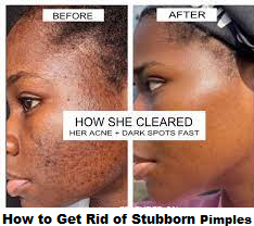 How to Get Rid of Stubborn Pimples