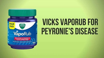 Vicks Vaporub for Peyronie's Disease