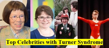 Top Celebrities with Turner syndrome