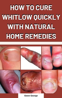 CURE WHITLOW QUICKLY WITH NATURAL HOME REMEDIES 1212